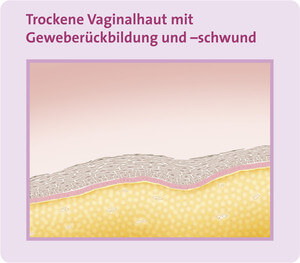 Abbildung trockene Vaginalhaut mit Geweberückbildung und -schwund